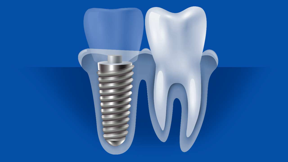 Titanium vs. Ceramic Dental Implants