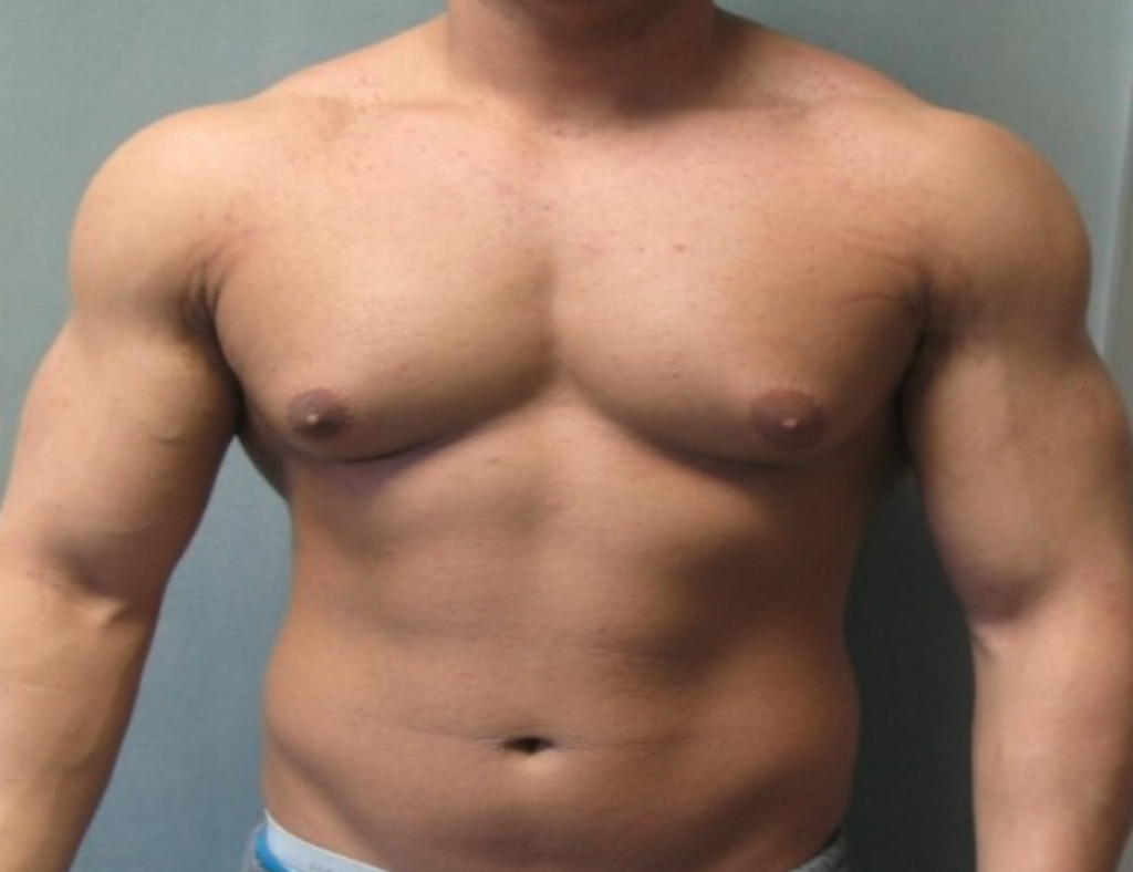 Gynecomastia - The Condition That Cause The Development Of “Man Boobs”