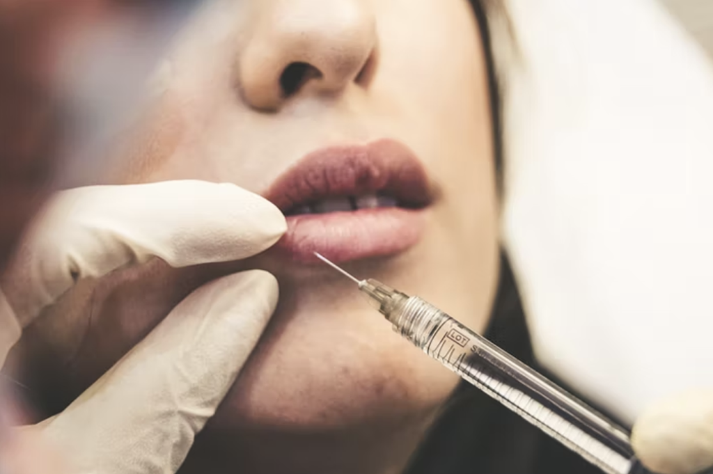 7 Top Benefits of Getting a Lip Filler