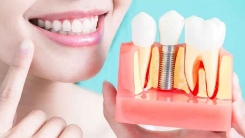 Affordable Dental Implants How to Get the Smile You Deserve on a Budget?