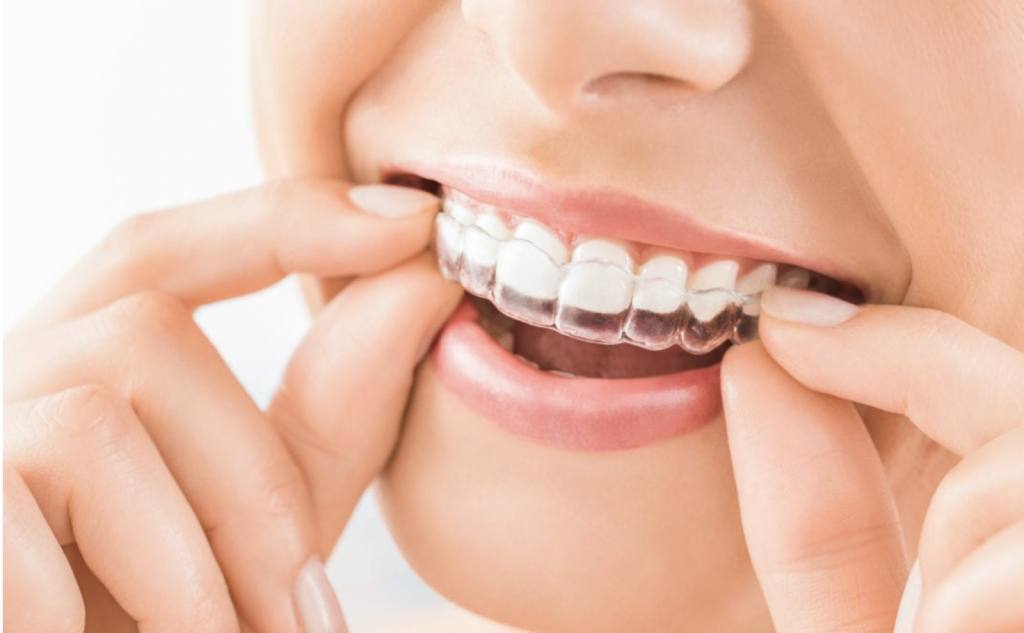 10 Strategies for Maximizing Your Invisalign Experience