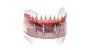 Transform Your Smile All-on-4 Dental Implants in Dallas, TX