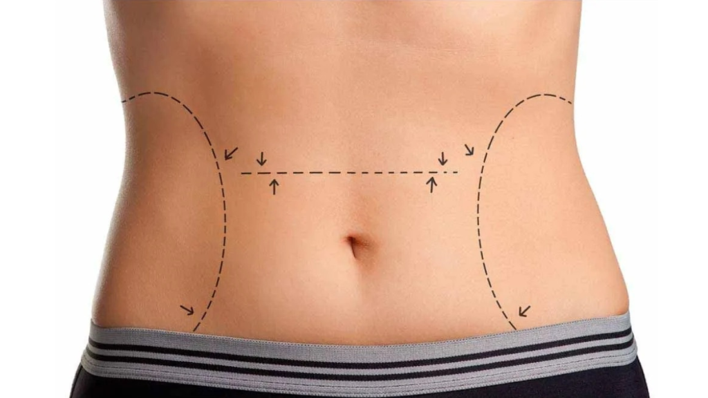 Expert Liposculpture Surgeons in Colombia Aesthetic Precision with Professional Backing